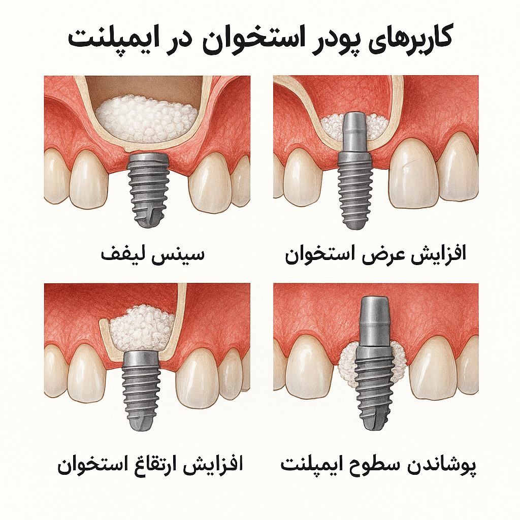 کاربردهای پودر استخوان در ایمپلنت