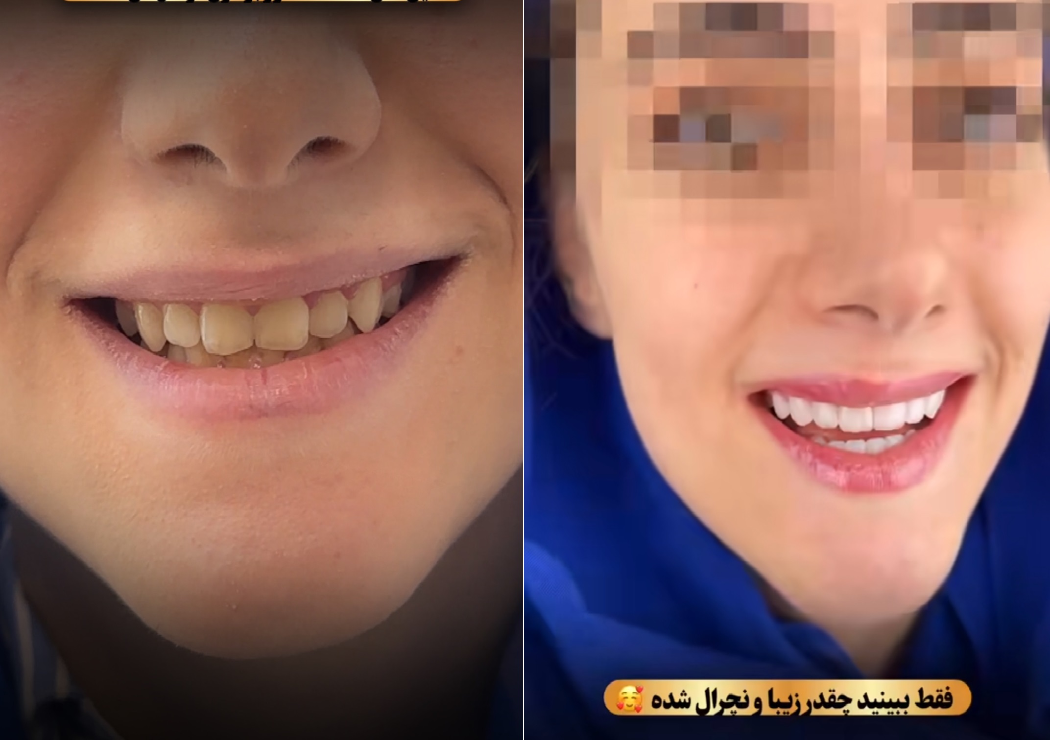  سفید کردن دندان 